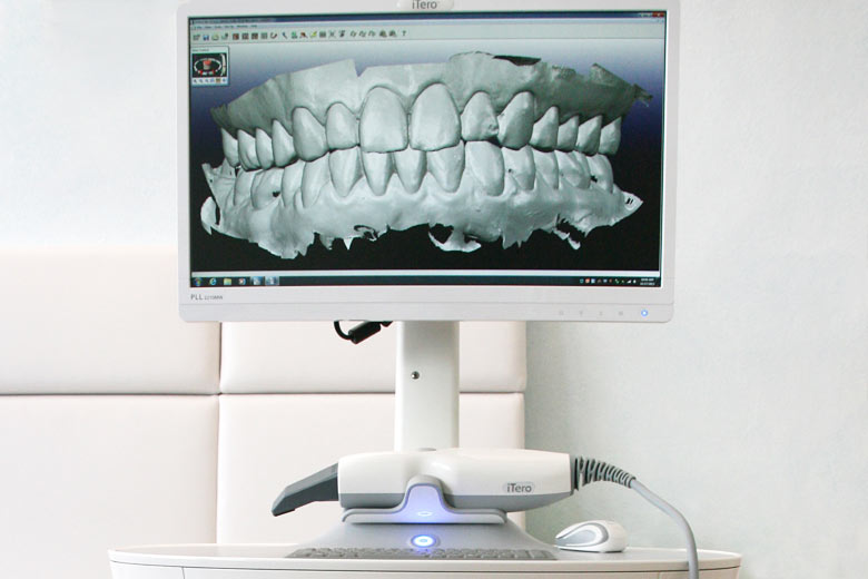 Intra-Oral Scanner